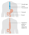 Diagram showing before and after a total oesophagectomy