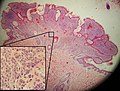 Micrograph of an intradermal melanocytic nevus
