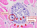 4 - Cellular arrangement, including crowding, or palisading in this case. Amount of mitoses can also be appreciated.
