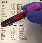 Blood specimen with CBC and differential results