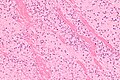 High magnification micrograph showing laminations in a thrombus in a fatal pulmonary embolism. H&E stain.