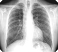 Chest X-ray showing uncomplicated silicosis