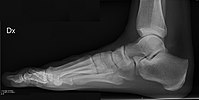 Normal foot, lateral projection
