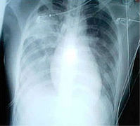 Chest film showing increased opacity in both lungs, indicative of pneumonia