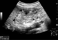 Figure 12. Patient with tuberous sclerosis and multiple angiomyolipomas in the kidney. Measurement of kidney length on the US image is illustrated by '+' and a dashed line.[1]