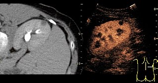 Figure 31. Unspecific cortical lesion on CT is confirmed cystic and benign with contrast-enhanced ultrasound (CEUS) using image fusion.[1]