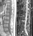 (a) T1-weighted and (b) short tau inversion recovery (STIR) magnetic resonance images of lumbar and lower thoracic spine in psoriatic arthritis. Signs of active inflammation are seen at several levels (arrows). In particular, anterior spondylitis is seen at level L1/L2 and an inflammatory Andersson lesion at the upper vertebral endplate of L3.