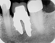 Röntgenaufnahme des wurzelanalogen Zahnimplantats mit zwei Wurzeln am linken unteren Molar