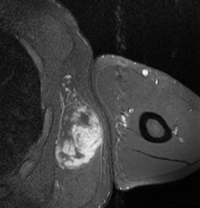 MRI of myxoid liposarcoma of high grade, in left axillary region of 40 year old man. Horizontal section.