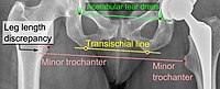 Leg length discrepancy after hip prosthesis surgery