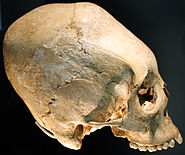 Turricephalus of a 30- to 40-year-old Alamannic woman of the early 6th century