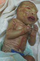 Harlequin ichthyosis in a female infant