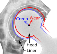 Liner creep and wear of a hip prosthesis