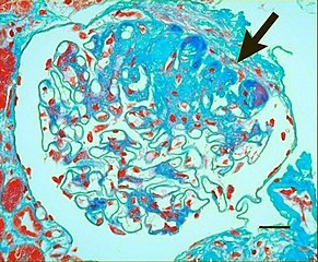 Light micrograph of glomerulus showing secondary segmental sclerosis of hypertensive nephropathy.