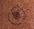 Malignant Melanoma in situ marked for biopsy, left forearm