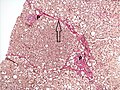 Histopathology of steatohepatitis with moderate fibrosis, with thin fibrous bridges (Van Gieson's stain)[84]