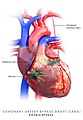 Coronary artery bypass graft, double bypass.