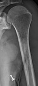 Humerus with multiple myeloma lesions