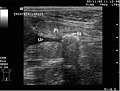 Ultra­schall­bild eines Harn­steins im Prostata­teil der Harnröhre beim Hund. (Ur=Urethra (Harnröhre), Pr=Prostata, St=Harnstein)