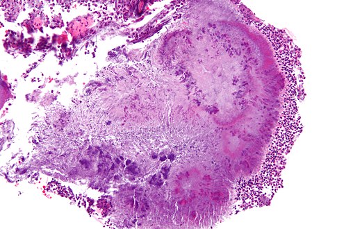 Micrograph of actinomycosis, H&E stain