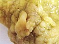 Gross examination of gallbladder carcinoma, with a prominent nodule.