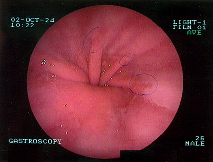 Upper GI endoscopy depicting hiatal hernia