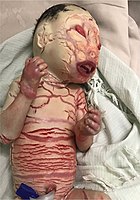 An infant with Harlequin ichthyosis.