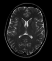 Normal axial T2-weighted MR image of the brain