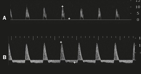 Graphs representing the color Doppler spectrum of the flow pattern of the cavernous arteries during the erection phases. A: Single-phase flow with minimal or absent diastole when the penis is flaccid. B: Increased systolic flow and reverse diastole 25 min after injection of prostaglandin.[45]