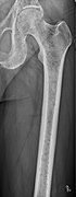 Femur with multiple myeloma lesions