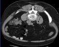 Axial CT scan of abdomen without contrast, showing a 3-mm stone (marked by an arrow) in the left proximal ureter