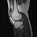 Knee MRI (T1 TSE sagittal)