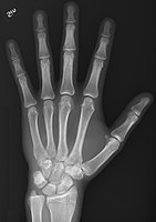 Normal hand, dorsoplantar projection