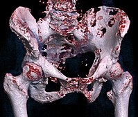 3D rendered CT of hip bone metastases