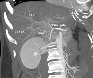 MDCT image. Arterial anatomy contraindicated for liver donation