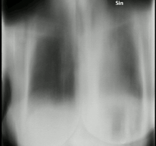 Tomosynthesis of the lungs of a woman who previously had aspergillosis, showing scarring consistent with chronic fibrosing pulmonary aspergillosis.