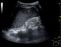 Figure 25. End-stage chronic kidney disease with increased echogenicity, homogenous architecture without visible differentiation between parenchyma and renal sinus and reduced kidney size. Measurement of kidney length on the US image is illustrated by ‘+’ and a dashed line.[1]