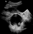 A complex cyst due to a dermoid as seen on ultrasound