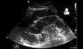 Small bowel obstruction on ultrasound[19]