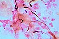 Gram stain of Candida albicans from a vaginal swab; the small oval chlamydospores are 2–4 μm in diameter