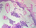Pinworms are sometimes diagnosed incidentally by pathology. Micrograph of pinworms in the appendix, H&E stain