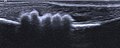 5 Harnsteine liegen in der Mitte des Penisknochens eines Hundes (hyper­echogene Linie) und führen zu einem Verschluss der Harn­röhre, die rechts als echo­freies Areal angedeutet ist