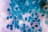 Ziehl–Neelsen stain of Mycobacterium tuberculosis