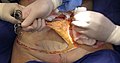 The removal of nearly 100 square centimeters of skin from the abdomen of a 40-year-old woman during an abdominoplasty surgery (also known as a "tummy tuck")