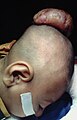Encephalocele on the head of a two-year-old.