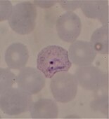 A malarial parasite, probably Plasmodium vivax, in a red blood cell