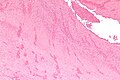 Low magnification micrograph showing laminations in a thrombus in a fatal pulmonary embolism. H&E stain.