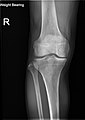 Knee X-ray (weight bearing)