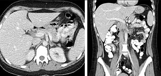 FIGURE 2. Contrast enhanced CT demonstrating parenchymal enhancement of the intra-abdominal organs in the portal venous phase (axial left, coronal reformat right).[citation needed]