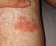 Atypical erythema migrans, 1 week after presentation